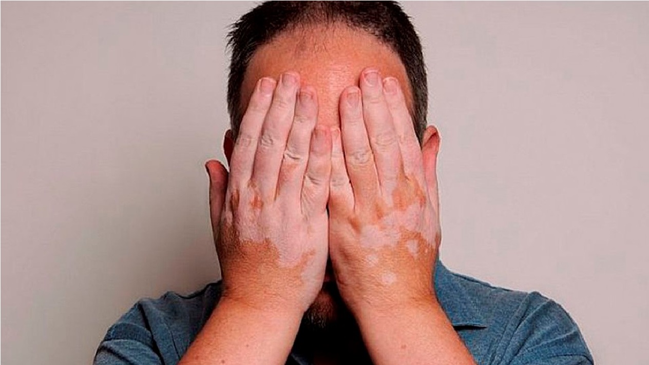 Jóvenes menores de 20 años los más afectados por vitiligo