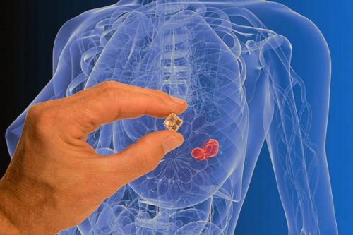 Contra cáncer de mama, nuevo dispositivo eléctrico