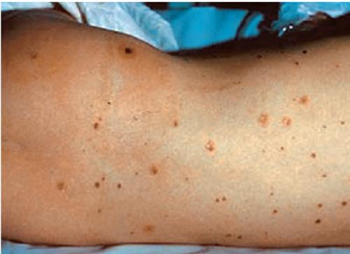 La enfermedad meningocócica puede causar la muerte en 24 horas