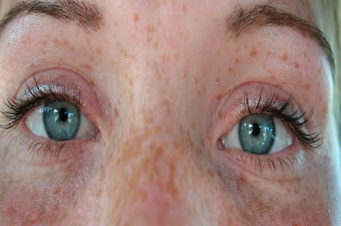 Las pecas no suelen ser señal de un trastorno oculto de la piel