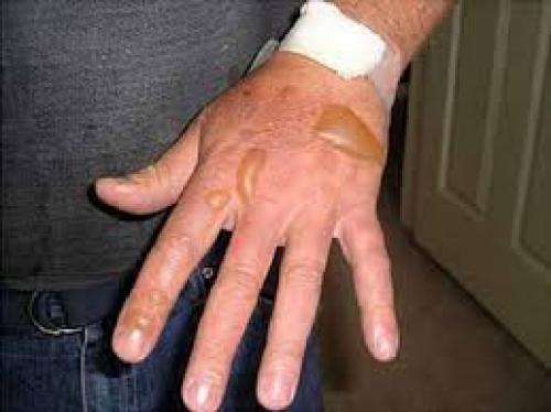 Se incrementan casos de quemaduras en niños por pirotecnia y accidentes en la cocina