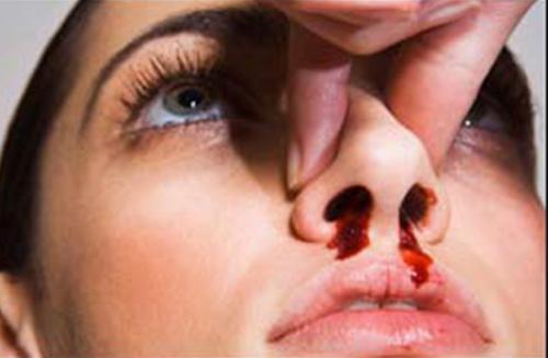 Sangrados nasales no deben preocupar