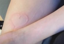 La rara enfermedad de esta joven convierte su piel en un lienzo