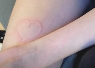 La rara enfermedad de esta joven convierte su piel en un lienzo