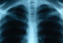 Reporta Tamaulipas más de mil casos de tuberculosis