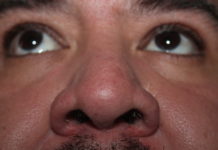 Anosmia el síntoma frecuente con Covid