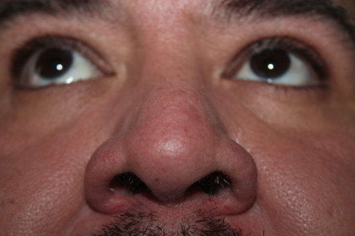 Anosmia. 03062021