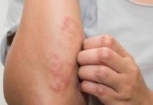 Tamaulipas en segundo lugar en casos de lepra; reportan cuatro contagios
