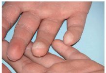 Enfermedades poco comunes afectan la salud de los tamaulipecos