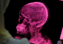 Estudio encuentra que el covid-19 altera el volumen de materia gris en el cerebro