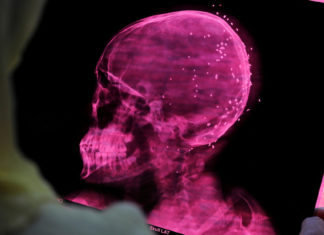 Estudio encuentra que el covid-19 altera el volumen de materia gris en el cerebro