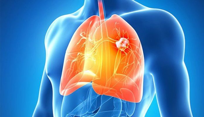 cáncer pulmón