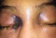 Tamaulipas podría tener el primer caso de “hongo negro”