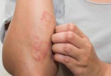 Tamaulipas en los primeros lugares de casos de lepra