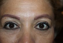Alertan a cuidarse de la Conjuntivitis