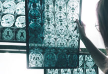 Científicos desarrollan un enfoque prometedor para una posible vacuna y tratamiento contra el alzhéimer