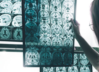 Científicos desarrollan un enfoque prometedor para una posible vacuna y tratamiento contra el alzhéimer