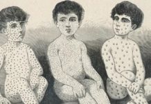 La carrera por entender la misteriosa “amnesia inmunológica” causada por el sarampión (y cómo puede afectar la protección contra el covid)
