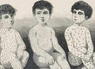 La carrera por entender la misteriosa “amnesia inmunológica” causada por el sarampión (y cómo puede afectar la protección contra el covid)