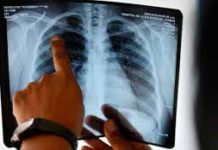 Aumentan el doble los casos de tuberculosis respiratoria