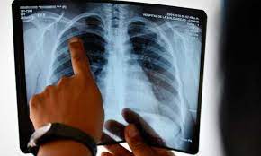 Tuberculosis