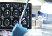 Un estudio descubre 42 nuevos genes relacionados con el riesgo de Alzheimer que permiten su diagnóstico temprano