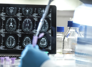 Un estudio descubre 42 nuevos genes relacionados con el riesgo de Alzheimer que permiten su diagnóstico temprano