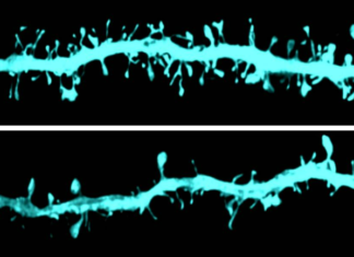 Las proteínas que predicen la enfermedad de Parkinson