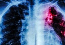 Monitorean en Tamaulipas a 870 casos de tuberculosis