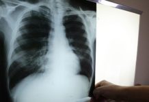 Hombres son los principales afectados por la tuberculosis