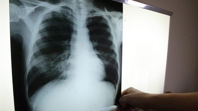 tuberculosis