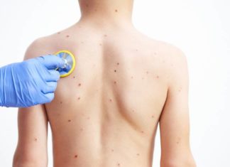 Viruela del mono: OMS advierte que contagios en niños empeorarán la crisis sanitaria