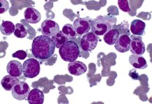 Miles de pacientes con linfoma podrían recibir un fármaco ‘caballo de Troya’ que destruye las células tumorales