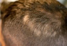 Descubren una molécula que ayuda a fomentar el crecimiento de cabello nuevo