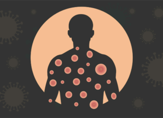 Piden vacuna contra viruela del mono para poblaciones prioritarias