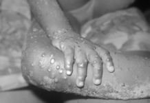 Viruela del mono: ¿Qué es y cómo afecta esta enfermedad?