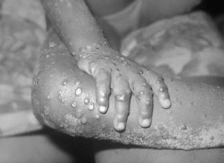 Viruela del mono: ¿Qué es y cómo afecta esta enfermedad?