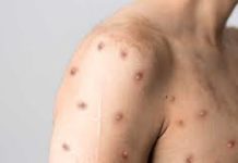 Neolonés se infecta del virus del mono en Tamaulipas