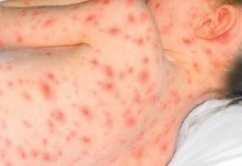 Se duplican casos de varicela en Tamaulipas