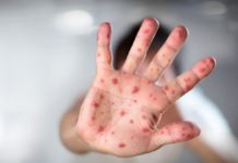 Alerta Salud por la viruela del mono, en Tamaulipas ya hay casos