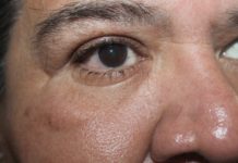 Alertan por casos recurrentes de Conjuntivitis