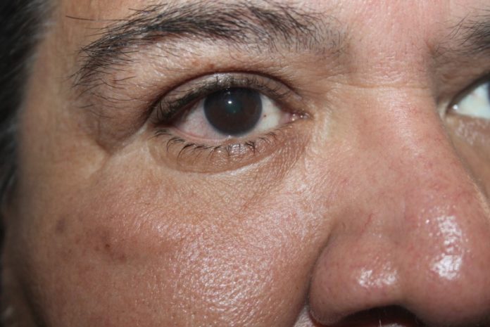 Conjuntivitis.11072022