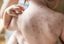 Se duplican casos de varicela en Tamaulipas
