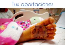 Piden apoyar tratamiento de niños con quemaduras
