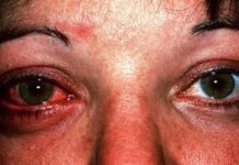 Conjuntivitis hace estragos en la salud; van más de 16 mil casos