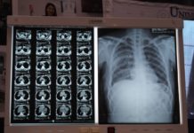 José urge de trasplante de pulmones