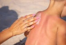 Atiende clínica DIF 20 casos de quemaduras por el sol en el año