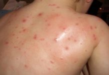 Casos de varicela se duplican; ya van 885 afectados