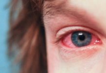 Más de 17 mil tamaulipecos afectados por la conjuntivitis
