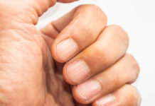 Líneas en las uñas podrían revelar que te hace falta este nutriente